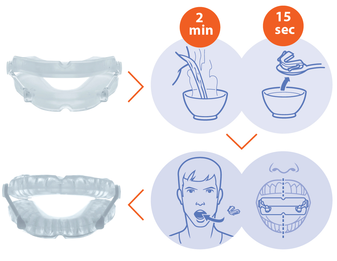 ONiRiS AntiRonquidos DAM Ortesis Avance Mandibular