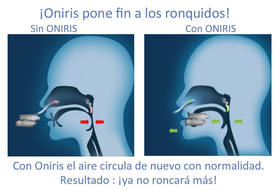 Oratek NoRonques Dispositivo de Avance Mandibular Anti-Ronquidos 